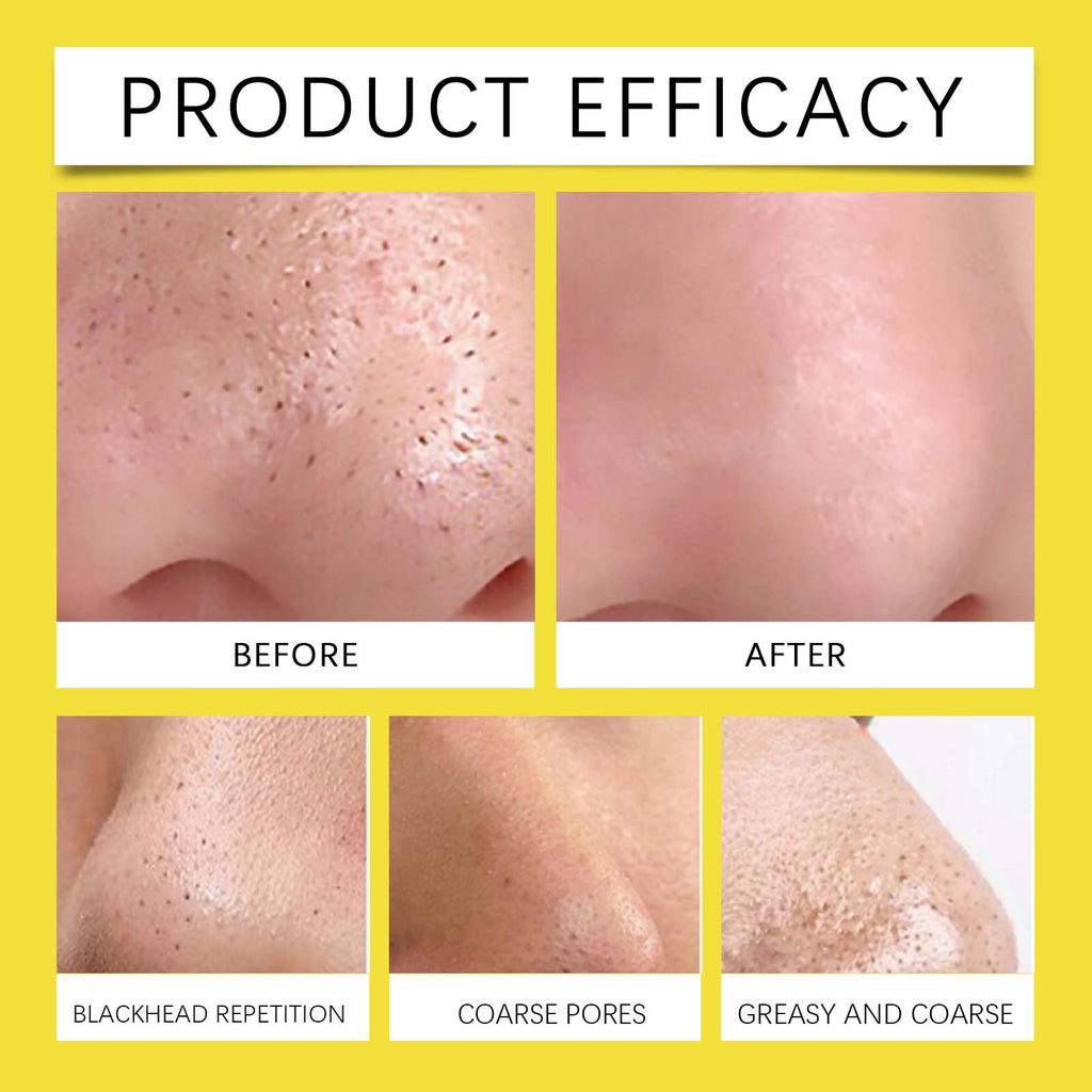 Hoygi Hydrocolloid Nose Patch, Hydrocolloid Invisible Concealer To Remove Blackheads And Acne Facial Pore Cleaning Nose Patch by Josla
