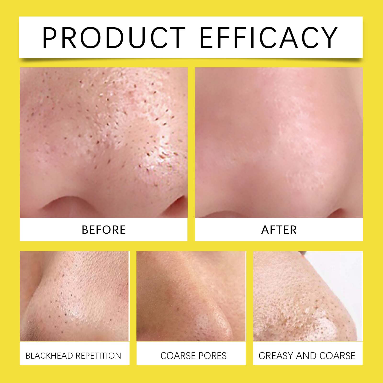 Hoygi Hydrocolloid Nose Patch, Hydrocolloid Invisible Concealer To Remove Blackheads And Acne Facial Pore Cleaning Nose Patch by Josla