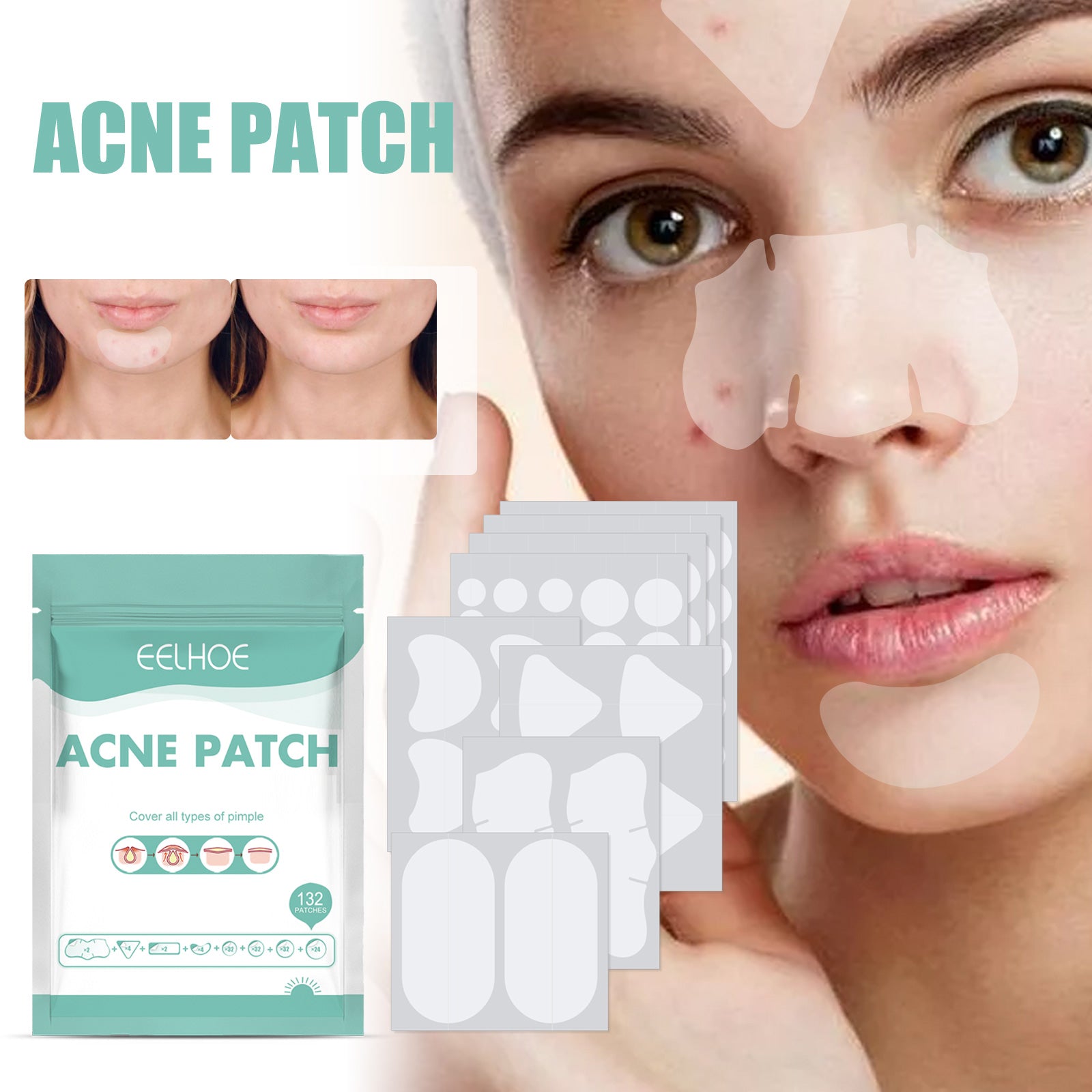 EELHOE Acne Relief Mask Patch Is A Gentle, Non-irritating Acne Mask That Helps To Reduce Acne Marks And Heal Acne. by Josla