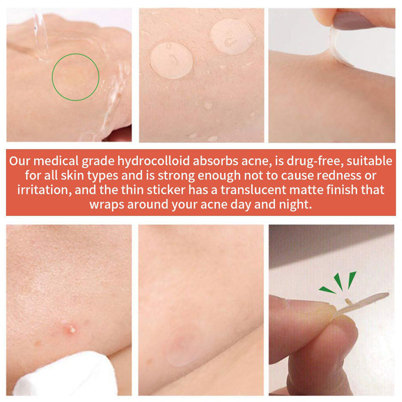 72 Count Acne Scar Patch,Nighttime Spot Stickers For Face And Skin,Shrinking Zits And Whiteheads by Josla